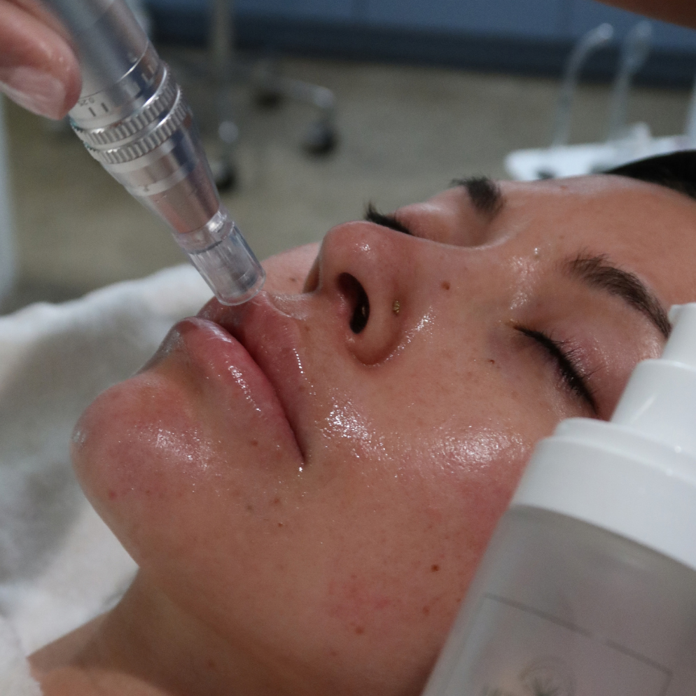 Microneedling Cartridge Guide: 12-Tip vs Nano Silicone vs Nano Surgical Steel